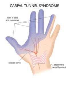 Carpal Tunnel Syndrome