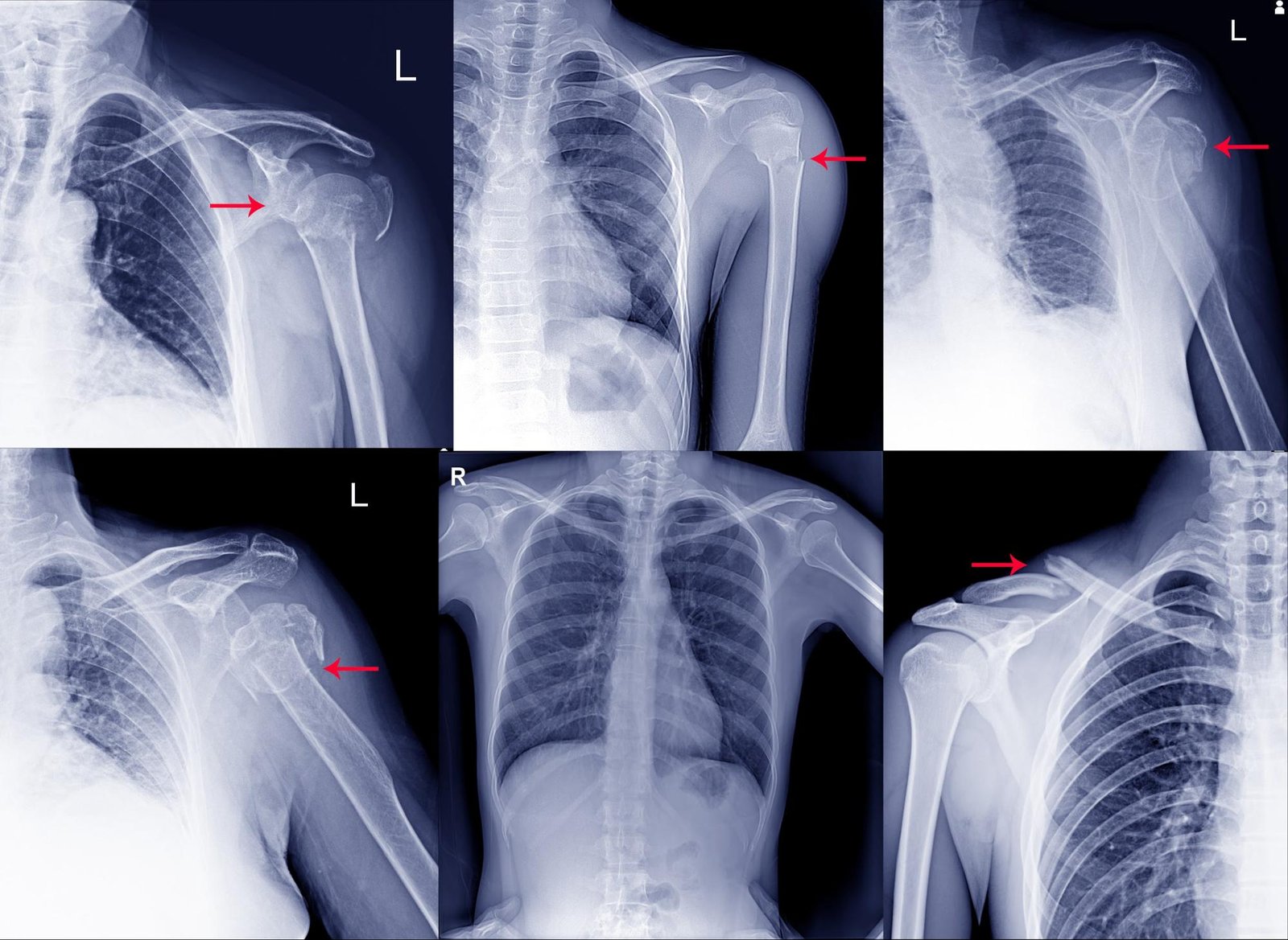 Several X-ray results showing different shoulder injuries