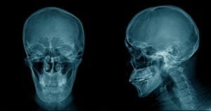 Front and side view of a skull x-ray image