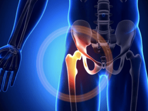 Hip Injury from Car Accident