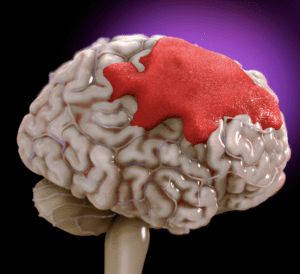 How Serious a Brain Bleed is After a Car Accident