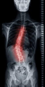 Traumatic Scoliosis from Car Accidents Settlements & Rights